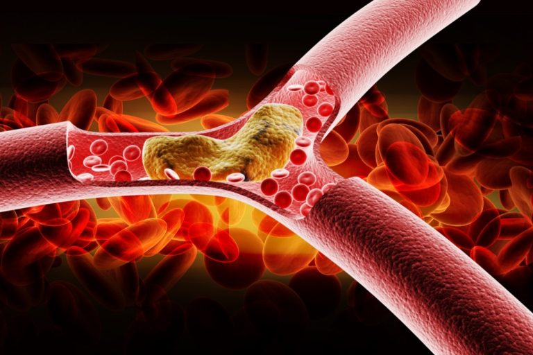 Sociedades Americanas de Cardiologia atualizam diretrizes para controle do colesterol